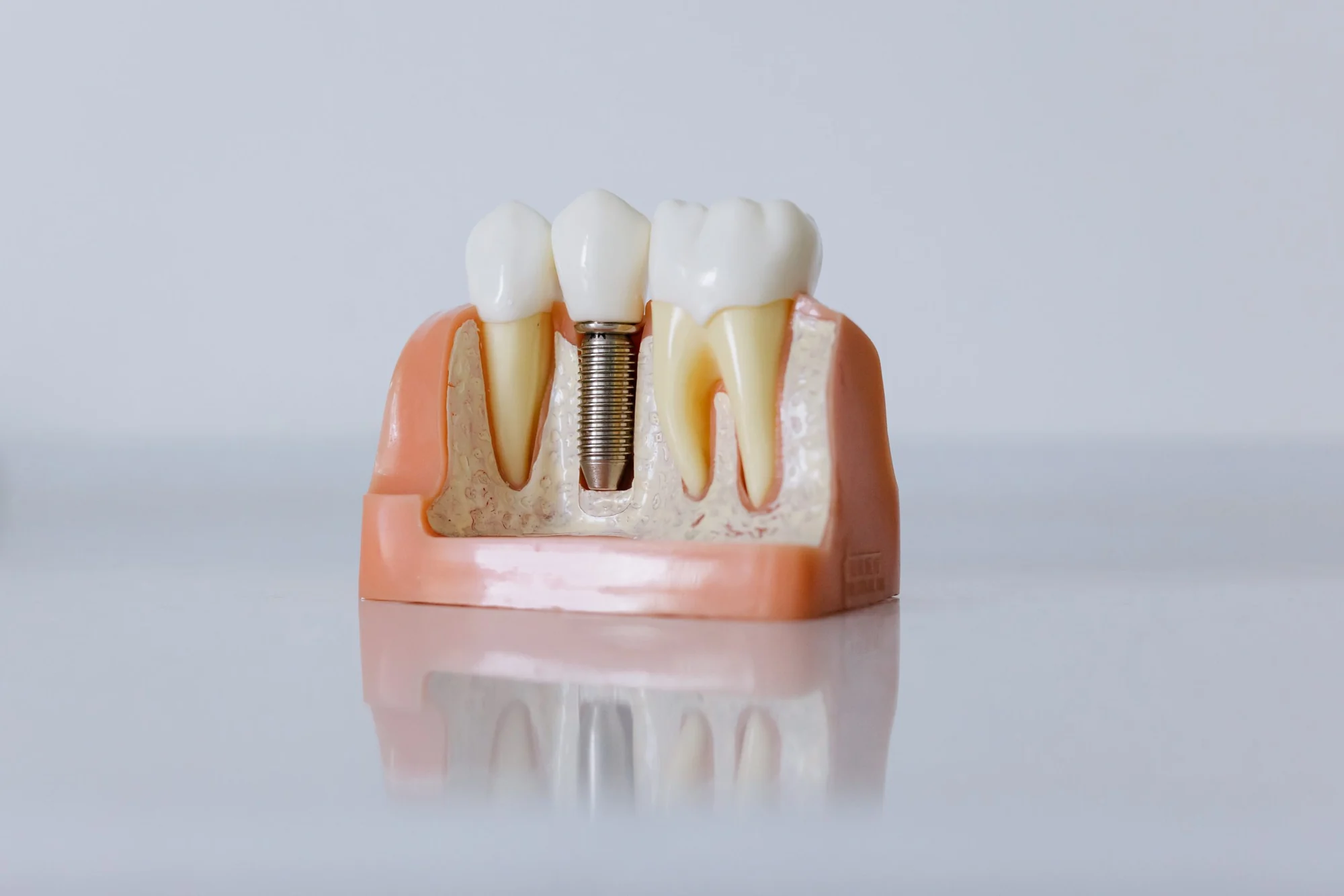 Dental restoration models used to illustrate tooth replacement options